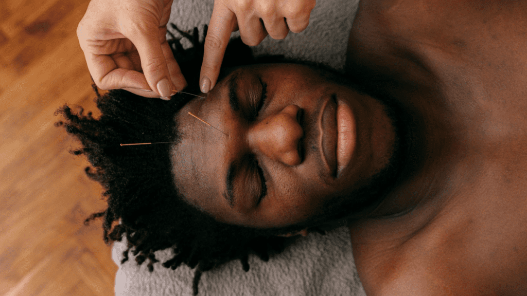 Facial acupuncture_4 | Treatwell