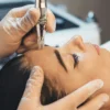 Close-up of professional microneedling treatment on woman's face in a clinic
