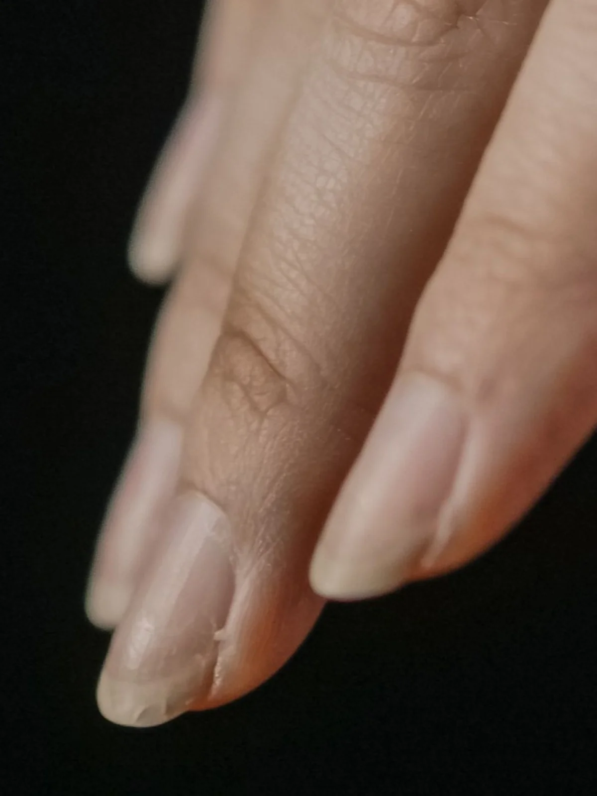 Close-up of a few fingernails showing peeling from the free edge
